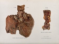Dissections of an ulcerated stomach caused by syphilis, and a severe case of ulcerated proctitis of the rectum : two figures. Chromolithograph by W. Gummelt, ca. 1897.