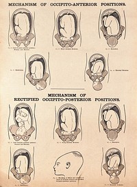 Mechanisms of occipito-anterior positions and rectified occipito-posterior positions of the foetus. Lithograph after W. F. Victor Bonney.
