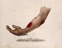 A forearm with three open wounds. Coloured stipple etching after J. Bell, c. 1815 .