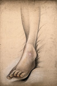 A sore with swelling on the foot of a woman. Watercolour with chalk by C. D'Alton, 18--.