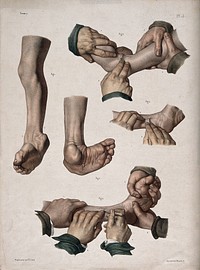 Clubfoot and the operation to cure the condition. Coloured lithograph by N.H. Jacob.