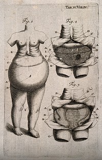 A woman with a distended stomach; with two dissected views of her abdomen. Engraving, c.1710.