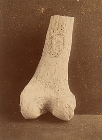 Lower end of right femur affected with pulmonary osteo-arthropathy (posterior view)