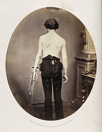 A young man, standing, unclothed to the waist and viewed from behind; his left arm appears deformed. Photograph by L. Haase after H.W. Berend, c. 1865.