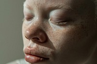 Woman with albinism skin forehead headshot.