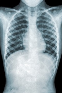 Chest x-ray of a patient with mycoplasma pneumonia. Original image sourced from US Government department: Public Health Image Library, <a href="https://www.rawpixel.com/search/cdc?sort=curated&amp;page=1">Centers for Disease Control and Prevention</a>. Under US law this image is copyright free, please credit the government department whenever you can&rdquo;.