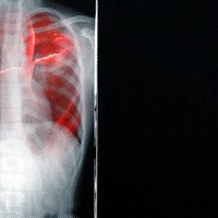 Respiratory tract infection shown on x-ray due to coronavirus 