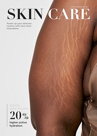 Body positivity poster editable template, stretch marks photo psd