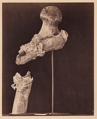 Lieutenant Goodwin, Deceased, Ununited Gunshot Fracture of the Upper Third of the Right Femur, Seven Months after the Injury, From the Photographic Catalogue of the Surgical Section