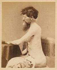 Private John Bar, Recovery after a Penetrating Wound of the Abdomen with Fracture of the Left Os Innominatum, from the Photographic Catalogue of the Surgical Section