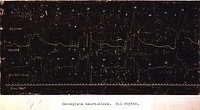 Electrocardiography: Graphs: Incomplete heart block.An early electrocardiograph showing an incomplete heart block. Original public domain image from Flickr