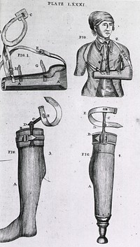 Arm sling and artificial legsCollection:Images from the History of Medicine (IHM) Author(s):Bell, Benjamin, 1749-1806, author Publication:Worcester, Massachusetts: Isaiah Thomas, 1791 Language(s):English Format:Still image Subject(s):Orthopedic Equipment Genre(s):Book Illustrations Abstract:Two types of artificial legs, one with a peg, the other with a foot; an arm sling to immobilize a broken arm. Related Title(s):Is part of: A system of surgery, Plate LXXXI.; See related catalog record: 2543021R Extent:1 print Technique:engraving NLM Unique ID:101435354 NLM Image ID:A012252 Permanent Link:resource.nlm.nih.gov/101435354