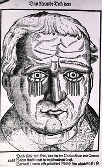 Treatment of EctropionCollection:Images from the History of Medicine (IHM) Author(s):Bartisch, George, 1535-approximately 1607, author Publication:[Dreszden: Matthes Stöckel], 1583 Language(s):German Format:Still image Subject(s):Ophthalmology Genre(s):Book Illustrations Abstract:Close-up of a man's head showing short lengths of cord hanging from the lower portion of the eyelid.  Related Title(s):Is part of: Ophthalmodouleia, das ist, Augendienst, l. 183 verso.; See related catalog record: 2221062R Extent:1 print Technique:woodcut NLM Unique ID:101435970 NLM Image ID:A016336 Permanent Link:resource.nlm.nih.gov/101435970