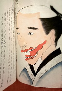 A facical tumor to be excised with general anesthesia. Image of an open illustrated manuscript showing the drawing of a man's face with a red tumor by his mouth to be excised with general anesthesia. Bunsen kiroku, p. 67. Original public domain image from Flickr