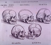 Bone PlateCollection:Images from the History of Medicine (IHM) Format:Still image Subject(s):Bone and Bones Genre(s):Book Illustrations Abstract:Five malformations of the skull. Related Title(s):Is part of: De humani corporis fabrica, p. 18 (Liber I).; See related catalog record: 2295009R Extent:1 print Technique:woodcut NLM Unique ID:101437397 NLM Image ID:A026919 Permanent Link:resource.nlm.nih.gov/101437397