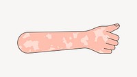 Vitiligo thumbs up hand, gesture collage element vector