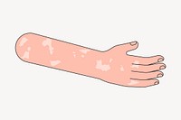 Vitiligo arm hand, body part flat illustration