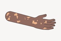 Black vitiligo hand, body part flat illustration
