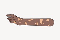 Vitiligo hand reaching out, gesture illustration