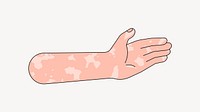 Vitiligo palm hand, gesture flat illustration