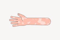White vitiligo hand arm, gesture illustration