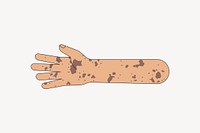 Tanned vitiligo hand arm, gesture illustration