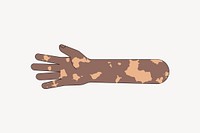 Black vitiligo hand arm, gesture collage element vector