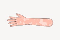White vitiligo hand gesture, flat illustration