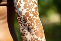 Vitiligo arm. 