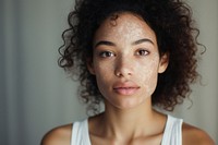 Vitiligo woman portrait. 