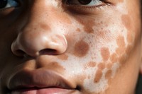 Woman's face with vitiligo skin, closeup. 