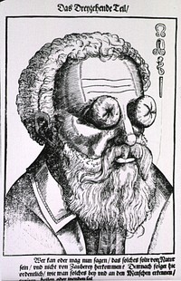 Fruit-like growths on the eyes. Close-up of the head of a man with large growths on his eyes; symbols in upper right corner (Bartisch believed this man's condition was the result of "witchcraft.") Original public domain image from Flickr 