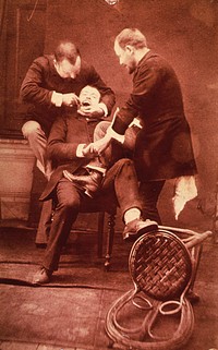 Tooth extraction. A patient is sitting in a chair; a dental assistant has his foot on the patient's lap; behind them the dentist has his arm around the patient's head and is working a dental instrument in the patient's mouth. In the foreground is an overturned chair. Original public domain image from Flickr