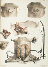 Various surgical procedures of the neck. Illustrations of the surgical repair of the bronchus, the Mayor technique for removal of a cancerous goiter, and steps for cutting the esophagus. Traité, vol. 7, pl. 26. . Original public domain image from Flickr