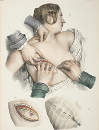 Publication:Bethesda, MD : U.S. National Library of Medicine, National Institutes of Health, Health & Human Services, [2010]. Three illustrations on a page showing mastectomy procedure. Some French text is visible on the facing page. Traité, vol. 7, pl. 27.. Original public domain image from Flickr