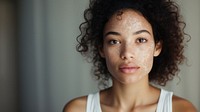 Vitiligo woman portrait. 