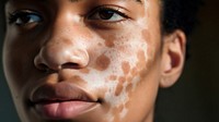 Woman's face with vitiligo skin, closeup. 