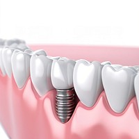 3d dental implants model , design resource. AI generated Image by rawpixel