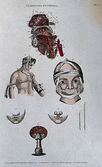 Anatomy, surgery and botany; top, dissected head showing arteries; centre, methods of bandaging the thorax and head; below, cleft lip (harelip) and instruments for surgery on it; bottom, fly agaric mushroom. Coloured engraving, 1834-1837.