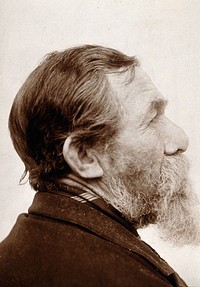 A patient of Léon Desguin, after operation. Photograph.