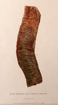 Part of the intestine showing signs of ileitis diphtherica following cholera asiatica. Chromolithograph by W. Gummelt, ca. 1897.