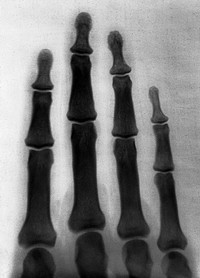 The bones of the human fingers. Photograph of X-ray attributed to L. Ropner, 1897.