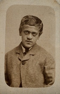 A young man, probably showing some signs of Down's syndrome. Photograph by Davis & sons.
