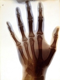 Hand of M.H. G[lyn]: radiograph. Photograph by Sir G.P. Glyn, ca. 1896.