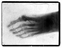 The bones of a pantomime artist's foot, viewed through x-ray; revealing a needle by one of the toes. Photoprint from radiograph after Sir Arthur Schuster, 1896.