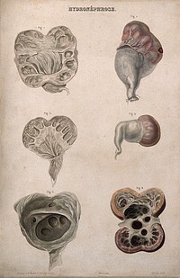 Several examples of a disease of the kidney whereby the accumulation of urine in the kidney pelvic region results in distention and atrophy, numbered for key. Colour etching by Oudet for Rayer.