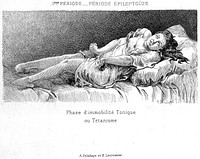 Études cliniques sur l'hystéro-épilepsie ou grande hystérie / par Paul Richer ; précédé d'une lettre-préface de J.-M. Charcot.