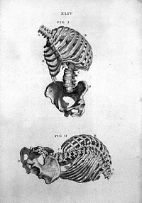 'Two views of the trunk of a crooked skeleton', 1733.