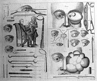 Ophthalmology instruments, eye growths, a cataract operation and other eye defects. Line engraving by R. Parr, 1743-45.