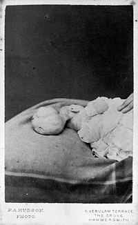 A baby with an encephalocele lying on a bed. Photographs by F.A. Hudson, 1869.